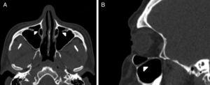 (A) Axial paranasal sinus CT image showing bilateral infraorbital canal Type 3 totally protruding into the maxillary sinus with a stalk (arrowheads). (B) Right parasagittal image showing infraorbital canal Type 3 (arrowhead).