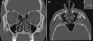 (A) Coronal paranasal sinus CT image showing bilateral infraorbital canal Type 4 which is located at the outer limit of the zygomatic recess and the horizontal distance (white dashed line) from the center of the IOF (arrows) to the plane passing through the priform aperture (arrowheads). (B) An oblique/axial image showing bilateral lateroantral canals (arrows) which are identified coursing laterally to the maxillary sinuses (asterisks) and opened by infraorbital foramina (curved arrows).