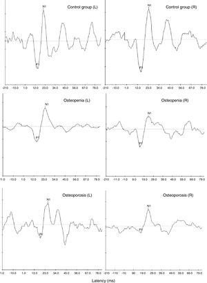 Representative cVEMP waveforms obtained from one participant with normal bone mineral density (top-most panel) and a participant each with osteopenia (middle panel) and osteoporosis (bottom-most panel).