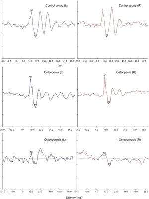 Representative oVEMP waveforms obtained from one participant with normal bone mineral density (top-most panel) and a participant each with osteopenia (middle panel) and osteoporosis (bottom-most panel).