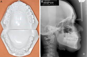 A, Study models used for assessment. These models were scanned so that the digital measurements could be performed. B, Radiographs used to assess the position of the incisors.