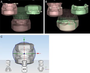 A, Overlapping of the models using the Maestro 3D Easy Dental Scan program (Upper Model); B, Overlapping of the models using the Maestro 3D Easy Dental Scan program (Lower Model); and C, Definition of the sagittal, occlusal and transverse planes (X, Y and Z) using the Maestro 3D Ortho Studio program.