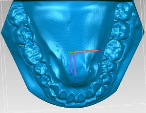 Visualization of intercanine and intermolar distance measurement.