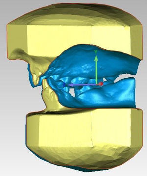 Measurement of Overjet (Plane Z) and Overbite (Plane Y) on digital model.