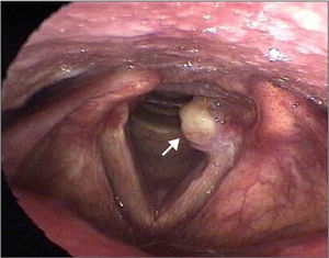 Vocal fold granuloma (arrow).