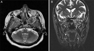 (A) Preoperative T1-weighted axial MRI. The mass is hypointense on the T1-weighted images (dashed-line indicates tumor). (B) Preoperative T2-weighted coronal MRI. The mass is mildly hyperintense on the T2-weighted images (arrow indicates tumor).