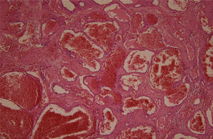 Histological examination. Branching vascular spaces consistent with hemangioma, H–E, 100×.
