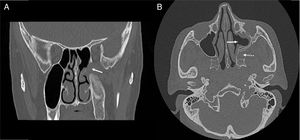 Postoperative CT images. (A) Coronal CT scan. There is no tumor recurrence in the pterygopalatine fossa (arrow indicates pterygopalatine fossa). (B) Axial CT scan. Left maxillary sinus and pterygopalatine fossa are seen normal (arrow indicates wide meatal antrostomy and dashed arrow indicates pterygopalatine fossa).