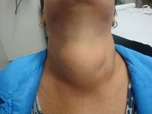 Large goiter in patients with hoarseness and respiratory distress.