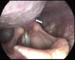 Hypopharyngeal projection of large goiter (ARROW).