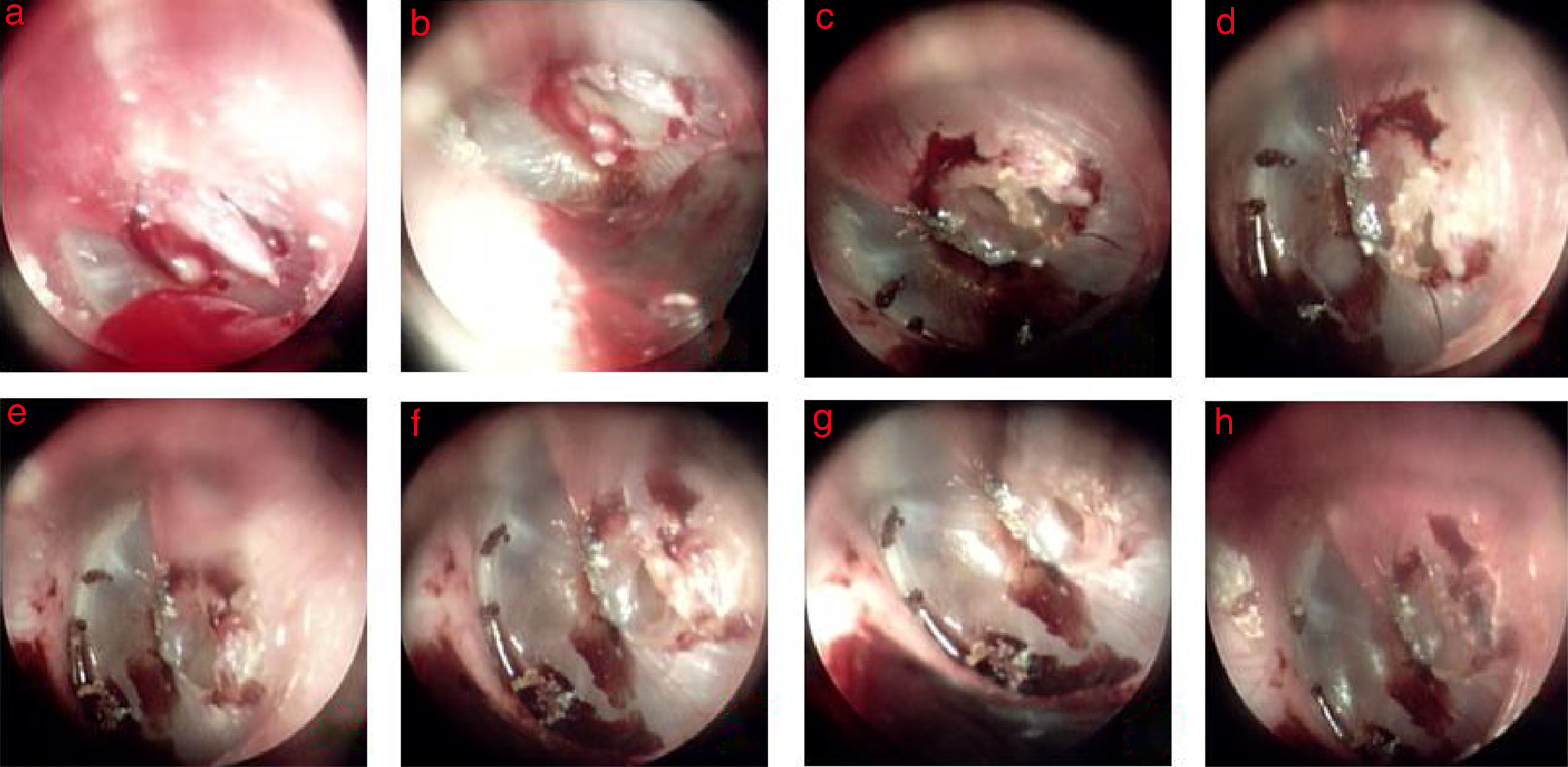 Inverted Ear Identification and management of inverted or everted edges of traumatic ...