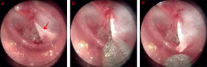 The process of edge approximation in the triangle perforation with everted eardrum: (a) 2nd days after perforation; (b) edge approximation; (c) everted eardrum was raised. Red arrows indicated everted eardrum.