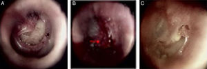The healing process after edge approximation in the kidney-shaped perforation with inverted eardrum: (A) 1st day after perforation; (B) edge approximation; (C) 6 days after edge approximation. Red arrows indicated inverted eardrum.