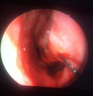 An image showing the reduction of left inferior turbinate of a patient using radiofrequency ablation technique. A conchal probe is inserted into the submucosal plane of inferior turbinate, and posterior, middle and anterior one thirds of the turbinate are ablated by a total of 300J of energy. S, Septum; IT, Inferior Turbinate; P, Conchal probe.