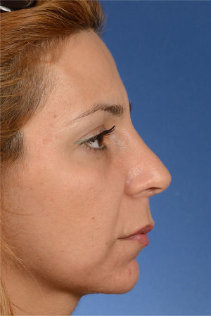 Iatrogenic cartilaginous hump as a result of inadequate adjustment of the septal height. Her VAS score for esthetic appearance of the nose was 86%, and her ROE score was 58%.