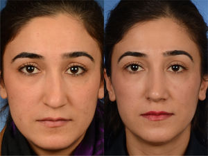 Partially corrected high dorsal deviation. Preoperative (left) and postoperative (right) frontal view of the patient are shown. Her VAS score for esthetic appearance of the nose was 77%, and her ROE score was 63%.