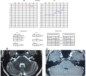 (A) Audiometry showing moderate sensorineural loss in the left ear. (B) T2-weighted MRI of the temporal bones, axial view, with hyposignal in the left vestibule. (C) T1-weighted MRI of the temporal bones, axial view, with contrast, lesion shows hyperuptake in the left vestibule.