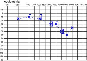 Audiogram of case 6.