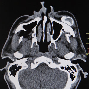 CT scan. Identification of the largest lesion, with a radiolucent interior and compact bone periphery and bulging of adjacent soft tissues.