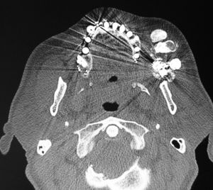 CT scan, bone window. View of three bone lesions and metallic fragments.