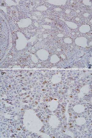 Severe nuclear CDC7 expression in adenoid cystic carcinoma (A, ×200; B, ×400).
