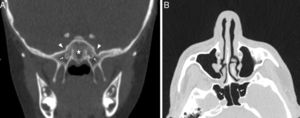 (A) Coronal CT section showing the conchal type sphenoid pneumatization pattern (star); (B) Axial CT section showing the intrasphenoid septum which deviated and attached on the carotid prominence (ICAS) (thick arrow).