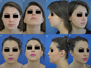 Case 1 (A–D) preoperative appearance of a patient with dorsal hump and a boxy tip. (E–H) Patient's postoperative appearance 7 months after being submitted to rhinoplasty. S.P.A.R. technique, cartilage graft in the radix, nasal tip strut and alar turn-in flap.