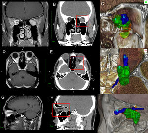 Comparison of T1-weighted MRI (A, D, G) with CT scan (B, E, H) and with 3D rendered (C, F, I) of Patient 1 with a massive orbital tumor. Note how the three-dimensional rendering gives depth to the image and improves the distinction between the ON (N) and orbital Tumor (T) which cannot be fully distinguished on either CT or MRI.