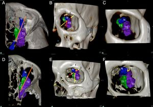3D rendered orbital tumors of Patients 3 (A, B, C) and 4 (D, E, F). Line 1 represents the long axis of the Optic Nerve (N) while Line 2 represents the plane of resectability. Note how these lines divide the tumor into 3 zones (T1) easily resectable, (T2) resectable and (T3) unresectable.