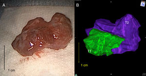 Comparison between resected orbital tumor and the 3-dimensional rendered tumor in Patient 2 demonstrating a close concordance in tumor size and morphology. Note in panel B that the different zones of the tumor were identified: (T1-green) easily resected tumor, (T2-purple) resectable tumor.