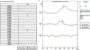 An example of automatic cortical auditory evoked potential threshold estimation to 4000Hz. In the example, the equipment considered response at 80 and 35dB HL. The black continuous line indicates the P1 latency considered by the three examiners.