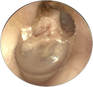 Posterior epitympanic cholesteatoma.