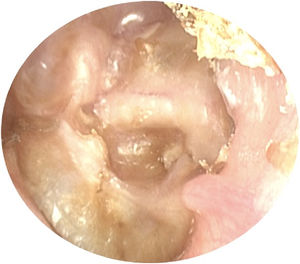 Two-route cholesteatoma.