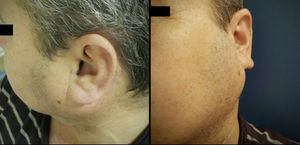 61-Year old patient with left parotid mass, on admission to the hospital.