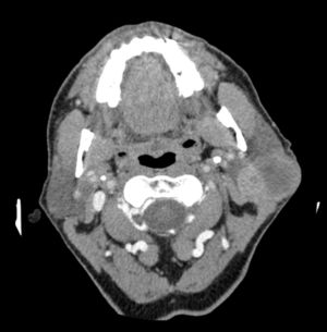 An enhanced CT scan of the parotid gland. Heterogeneously enhanced, left parotid mass, involving both lobes of the gland.