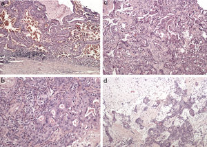 The histopatology of the resected specimen showing (A) Warthin tumor composed of lymphoid and epithelial cells, (B, C) malignant epithelial cells of carcinoma ex pleomorphic adenoma, in the background of (D) pleomorphic adenoma.