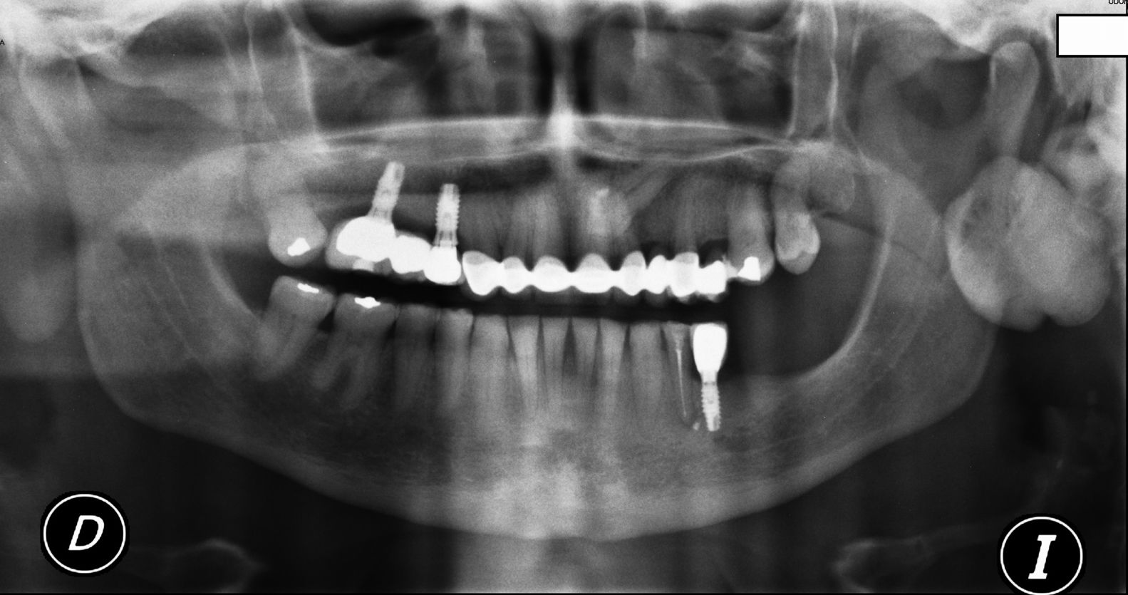 Giant peripheral osteoma of the mandible simulating a parotid gland ...