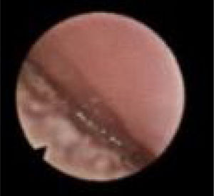 Fiberoptic view of transoral DISE showing the oral tongue pushing the palate (positive tongue palate interaction).