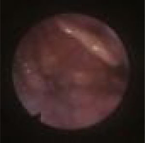 Fiberoptic view of Epiglottic collapse (Floppy epiglottis).