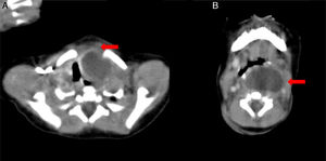 Preoperative computed tomography scan shows 4.5cm×3cm size unilocular low density cystic mass which is extended into superior mediastinum with compressing the trachea. A, red arrow: intrathoracic lesion. B, red arrow: superior lesion.