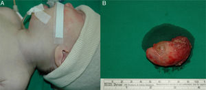 Patient photograph of the operating field. Note the diffuse swelling of the left anterolateral neck (A). About 5cm×2cm×2cm size soft, lobulated cystic mass which was filled with clear yellowish colored fluid (B).