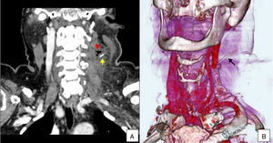 Contrasted CT scans revealing the presence of a foreign body (arrow) and gas consistent with an abscess (arrow head) in the left parapharyngeal region. (A) Coronal CT slice and (B) reconstructed 3D CT slices showing the fish bone lodged in the left parapharyngeal region (arrow).