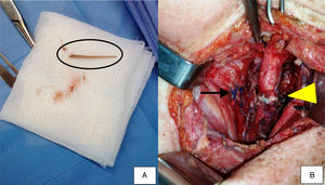 Surgical procedure. (A) In detail, the fish bone (black circle) which perforated the esophagus and caused a pseudoaneurysm to the left common carotid artery. (B) Sutured esophagus after removal of the fish bone (arrow) and end-to-end anastomosis of the left common carotid artery (arrow head).