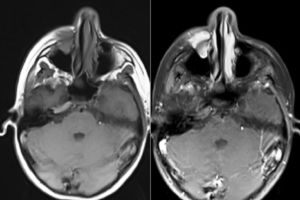 A axial MRI of the sinuses revealed a mass in the right maxillary sinus.