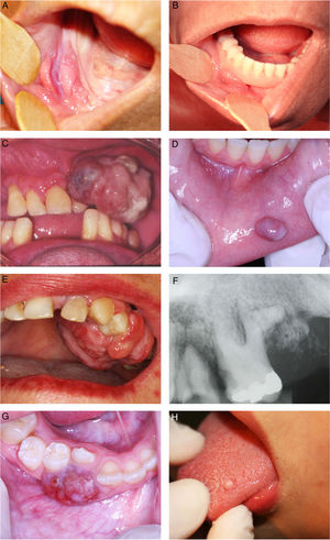 (A) Inflammatory fibrous hyperplasia; (B) ill-fitting denture over the inflammatory fibrous hyperplasia; (C) oral pyogenic granuloma in the alveolar ridge; (D) oral pyogenic granuloma in the lower lip; (E) peripheral ossifying fibroma; (F) periapical radiography of the peripheral ossifying fibroma; (G) peripheral giant cell lesions; (H) giant cell fibroma.