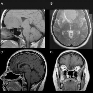 Patient 1, female, 49 years old. (A, B) Preoperative MRI without a contrast showing a large mass in the anterior fossa with mass effect. The anterior cerebral arteries are displaced posteriorly and there is invasion of the anterior and posterior ethmoid. (C, D) Postoperative 4 years MRI with contrast, showing gross total resection and no signs of tumour recurrence or brain herniation. Both flaps can be seen with gadolinium enhancement and preservation of the pedicles and viability of the endoscopic double flap.