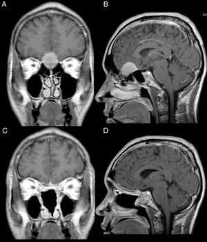 Patient 2, male, 39 years old. (A, B) Preoperative MRI with contrast showing an intracranial mass with dural attachment and invasion of the anterior and posterior ethmoid. (C, D) Postoperative 1 year MRI with contrast, showing gross total resection and no signs of tumour recurrence or brain herniation. Both flaps can be seen with gadolinium enhancement and preservation of the pedicles and viability of the endoscopic double flap.