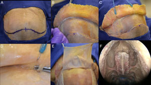 Step by step of a dissection showing how to raising the pericranial flap, the pictures was done in a cadaver. (A) Bicoronal incision was performed, approximately 1.5cm anterior to each external acoustic meatus and crossing the scalp posteriorly to the coronal sutures. (B) After this initial incision, the skin flap is elevated anteriorly up to about 10mm above the orbital rim, through the loose areolar layer, a typically avascular layer reducing bleeding and blood loss. The pericranium and temporal muscles were kept adhered to the skull at this time. (C) In a lateral view, it is feasible to visualize the left superficial temporal artery and the fascia exposed. (D, E) This flap is supplied by the supra-orbital and supratrochlear arteries and its branches (superficial branches to the skin and deep branches to the flap), in the picture is emphasized the supraorbital nerve. The pericranial flap is then elevated anteriorly from the skull all the way to the orbital rims, leaving the last 10mm adhered to the skin (both skin an pericranium are elevated from the skull together beyond this point). (F) In the nose, it is necessary to prepare the way to receive the flap and avoid any infection or Mucocele posteriorly, so it is mandatory to perform a Draf III (modified endoscopic Lothrop) allowing the passage of the pericranial flap posteriorly to the skull base to the nasal cavity. The Draf III is the communication of the right and left frontal sinus and removing any internals septa.
