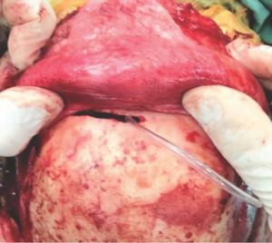 Intraoperative picture showing the ‘window’ created in the anterior wall of the frontal sinus for passage of the pericranial flap.