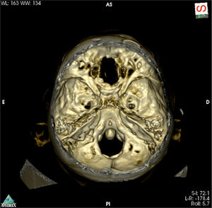Tridimensional reconstruction of postoperative high definition head CT with a large bone defect from the planum sphenoidale to the crista galli.